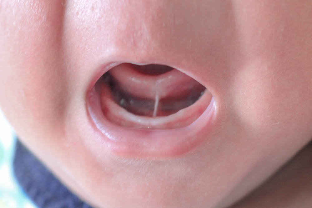 Tongue Tie Management